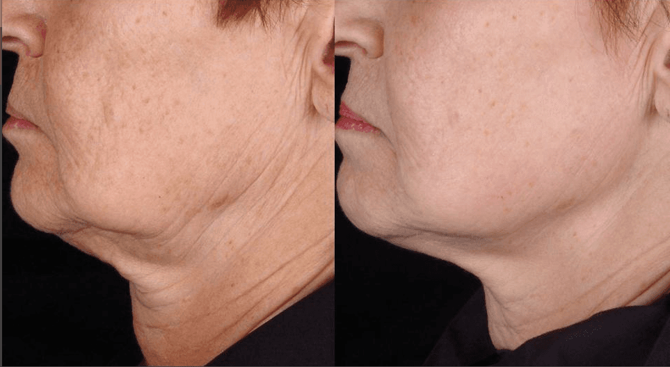 Skin Tightening Philadelphia Tighten Jowls & Flabby Skin